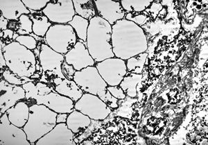 M,50y. | Pneumocystis carinii - lung